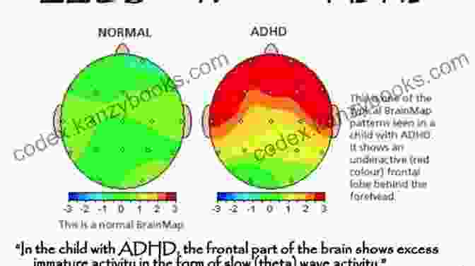 Diagram Of An ADHD Brain With Arrows Highlighting Differences In Activity Patterns Highlights From Ritalin Free Kids Dion Leonard