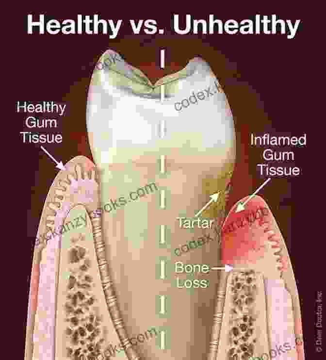 Periodontal Disease Affects The Tissues Surrounding The Teeth. The Link Between Oral Microbes And Systemic Health Issues: Function Health Guide To Periodontal Bacteria