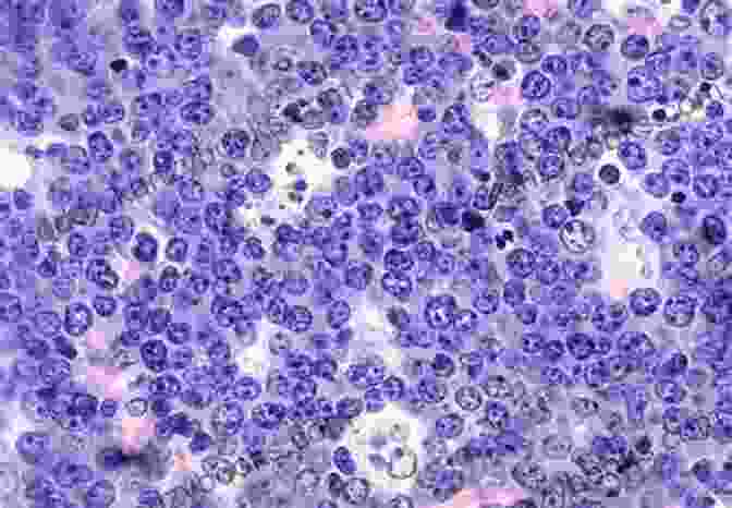 Photo Of A Lymph Node Affected By Burkitt's Lymphoma Cancer Virus: The Discovery Of The Epstein Barr Virus