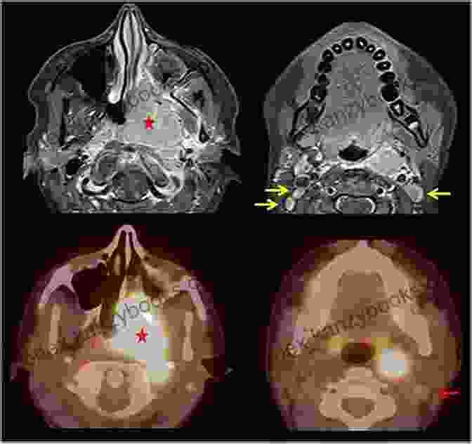 Photo Of A Nasopharyngeal Carcinoma Cancer Virus: The Discovery Of The Epstein Barr Virus